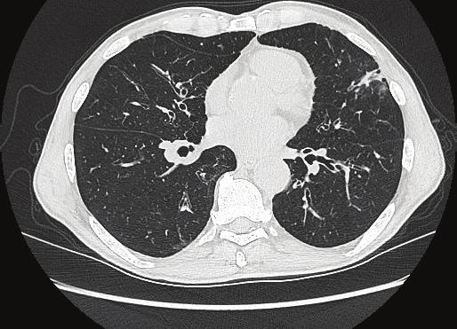 Abiejų plaučių bronchektazės sergant ne tuberkuliozės mikobakterijų sukelta plaučių liga (M. avium) 2 pav.
